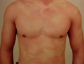 urticaria