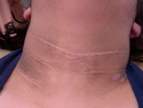 acanthosis nigricans