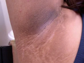 acanthosis nigricans