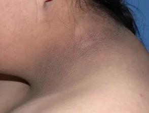 Acanthosis nigricans