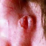 acanthoma-fissuratum-01__protectwyjqcm90zwn0il0_focusfillwzi5ncwymjisinkildg1xq-4306718-4807270-jpg-8923675