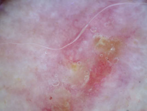Acanthoma fissuratum - vista de dermatoscopia