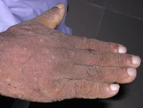 Acanthosis nigricans