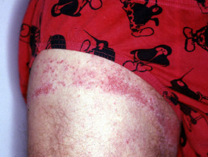 Dermatitis del caucho