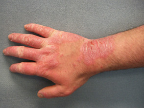Dermatitis de contacto alérgica al caucho