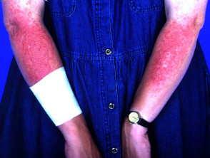 Dermatitis por fotocontacto