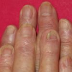 acitretin-nails__protectwyjqcm90zwn0il0_focusfillwzi5ncwymjisingildfd-5213070-5648265-jpg-7495715