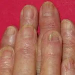 acitretin-nails__protectwyjqcm90zwn0il0_focusfillwzi5ncwymjisingildfd-5213070-5648265-jpg-7495715