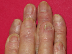 Adelgazamiento de uñas con acitretina