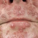 acne-agminata1__protectwyjqcm90zwn0il0_focusfillwzi5ncwymjisingildixxq-9663155-1100094-jpg-1212485
