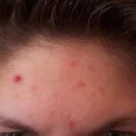acne-excorie__protectwyjqcm90zwn0il0_focusfillwzi5ncwymjisingildfd-2010921-6777317-jpg-4206205