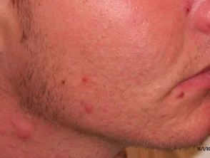 acne in het gezicht