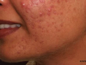 acne in het gezicht