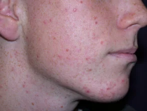 acne-face_1_15