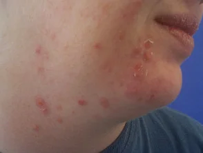 acne in het gezicht