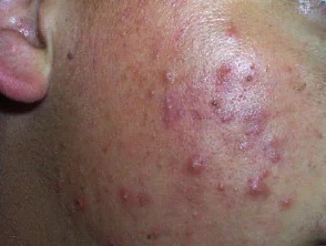 acne in het gezicht