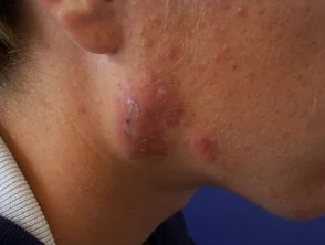 acne in het gezicht