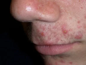 acne-face_1_23