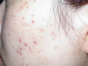 acne-face_1_28