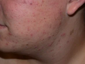 acne-face_1_29