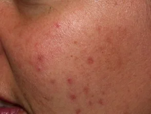 acne-face_1_31