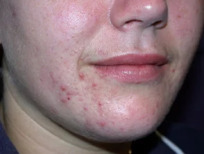 acne in het gezicht