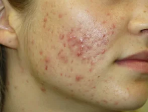 acne-face_1_43