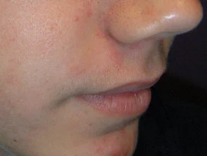 acne-face_1_44