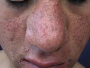 acne-face_1_48