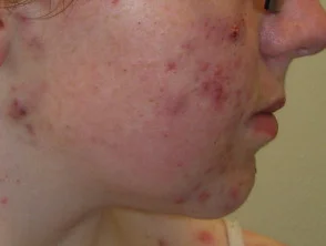 acne-face_1_51