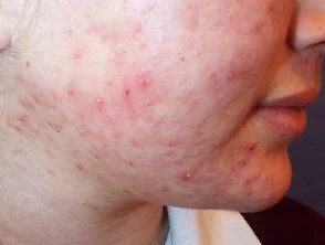 acne in het gezicht