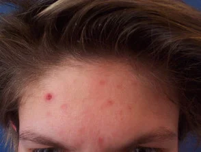 acne in het gezicht