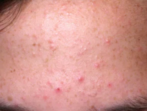 acne in het gezicht