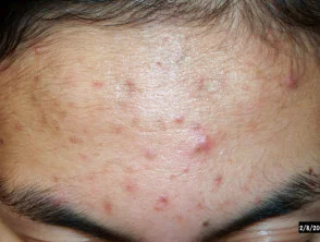 acne-face_1_9