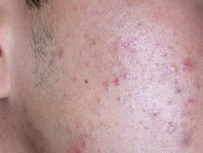 acne in het gezicht