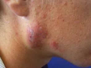 acne in het gezicht