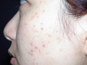 acne in het gezicht