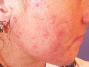 acne in het gezicht