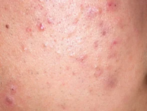 acne in het gezicht