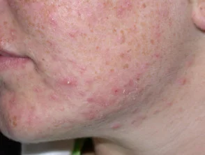 acne in het gezicht