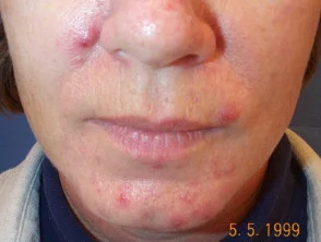 acne in het gezicht