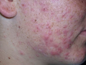 acne-face_14_1