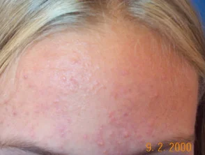 acne in het gezicht