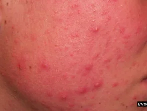 acne in het gezicht