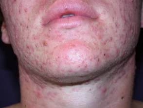 acne-face_19_1