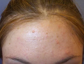 acne in het gezicht