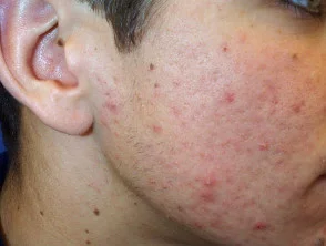 acne in het gezicht