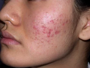 acne-face_2_12