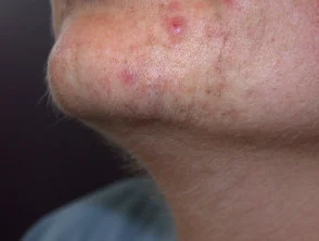 acne-face_2_19