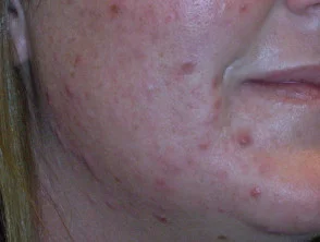 acne-face_2_26